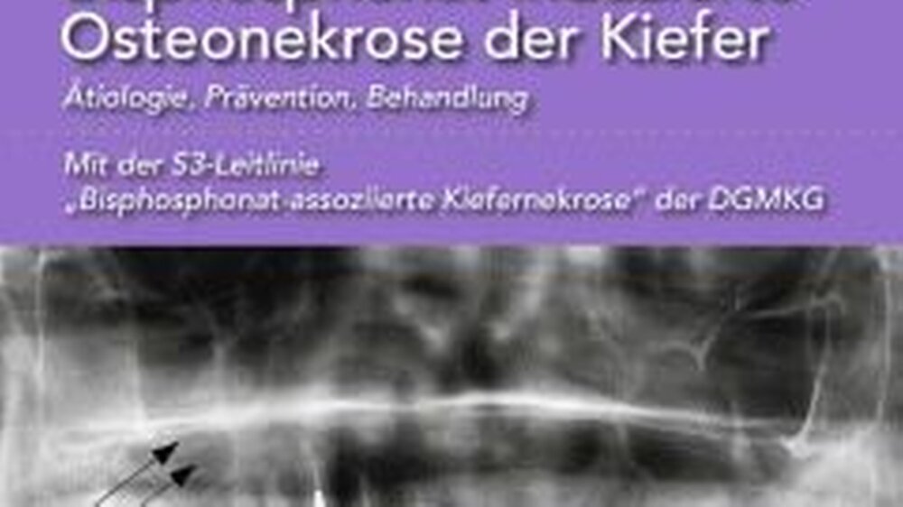 Robert E. Marx: Bisphosphonat-induzierte Osteonekrose der Kiefer. Ätiologie, Prävention, Behandlung. Mit der S3-Leitlinie „Bisphosphonat-assoziierte Kiefernekrose“ der DGMKG. ISBN: 978-3-86867-107-0 88,00 Euro | Robert E. Marx: Bisphosphonat-induzierte Osteonekrose der Kiefer. Ätiologie, Prävention, Behandlung. Mit der S3-Leitlinie „Bisphosphonat-assoziierte Kiefernekrose“ der DGMKG. ISBN: 978-3-86867-107-0 88,00 Euro |