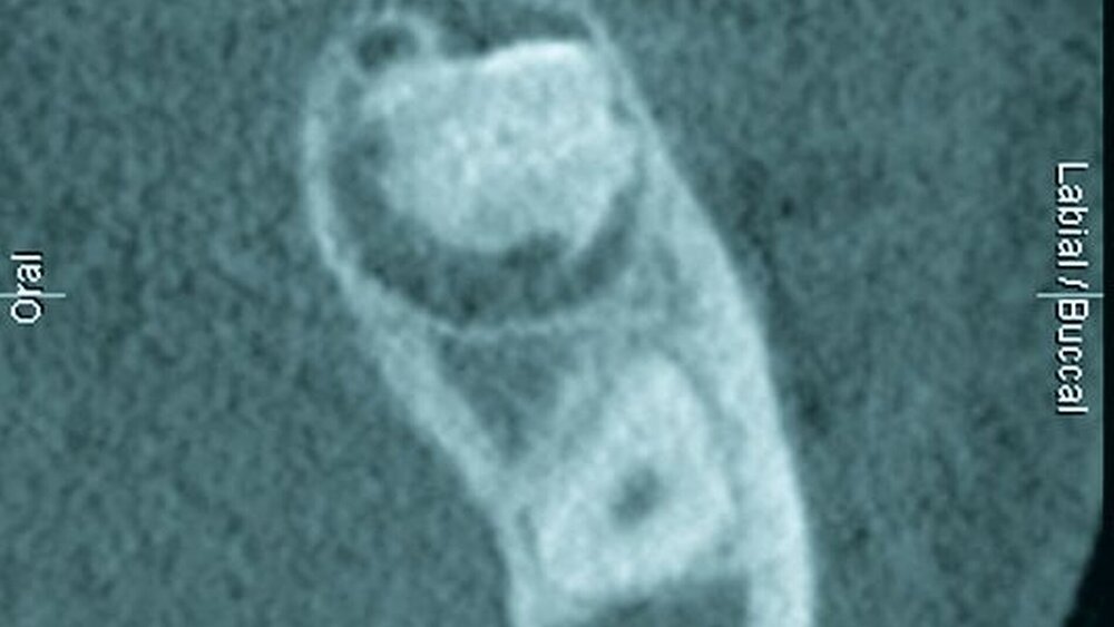 Abbildungen 2a und 2b: Dentales Volumentomogramm: a) enge Lagebeziehung der Wurzel von Zahn 35 zum Nervus alveolaris inferior. |