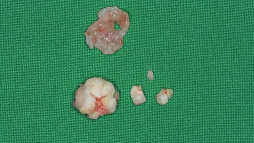 Abbildungen 4a und 4b: Odontom ex situ: a) Zu erkennen ist ein Konglomerat aus dentin- und schmelzartigen Bestandteilen umgeben von Resten der Kapsel. |