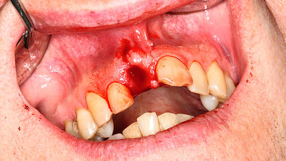 Abbildung 2: Avulsion Zahn 11 nach Badeunfall: Eine zeitnahe Replantation des Verlust gegangenen Zahnes mit Einleitung der Sofortmaßnahmen am Unfallort (Zahnrettungsbox) kann die Prognose des Zahnes erheblich verbessern.  |