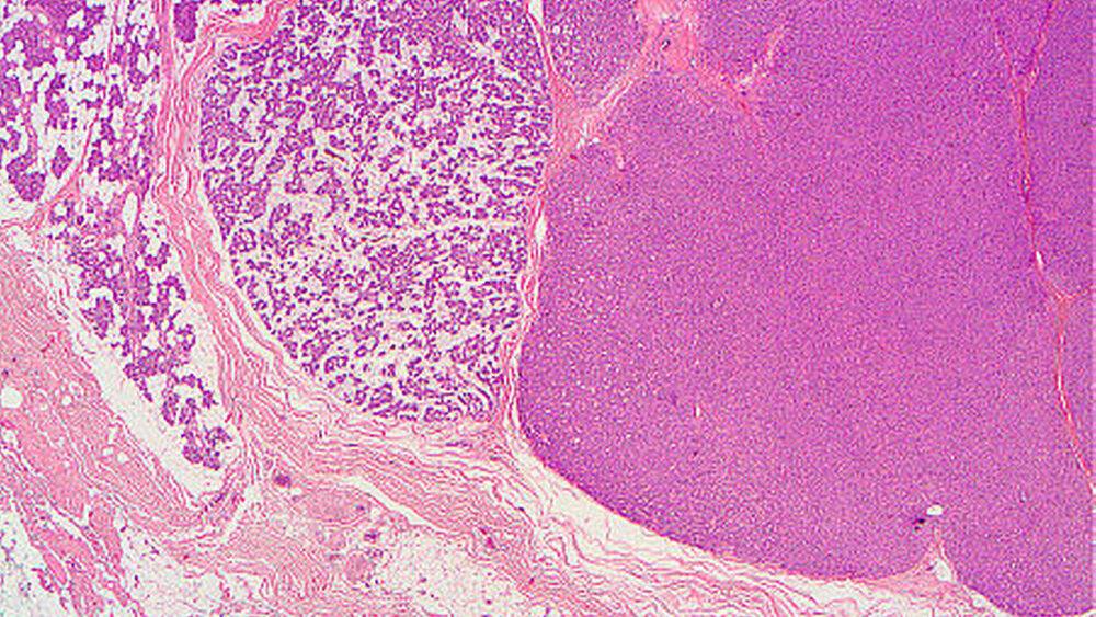 Abbildung 5: Zellreiches pleomorphes Adenom: Läppchenförmiger Tumor mit bindegewebiger Begrenzung zum Speicheldrüsengewebe |