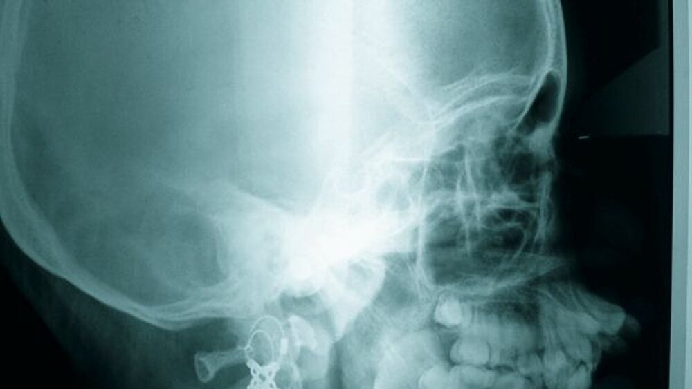 Abbildung 5: Im FRS ist die Protrusion der Prämaxilla bei ansonsten weitgehend normalen skelettalen Verhältnissen zu eruieren. |