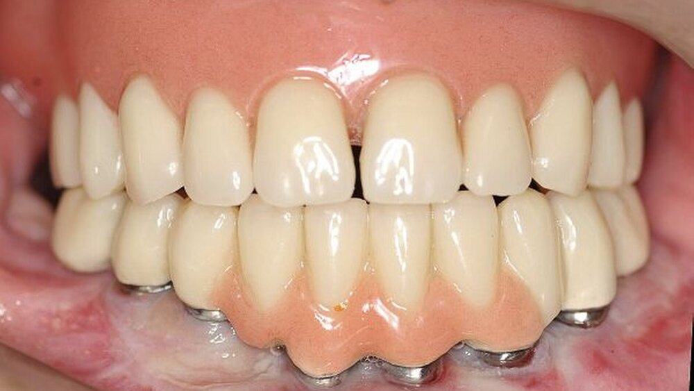 Abbildung 11: Gerüst- und Wachsanprobe, Ansicht von frontal: Das Sekundärgerüst zeigte eine gute Passung sowie eine funktionelle und ästhetische Zahnaufstellung. |