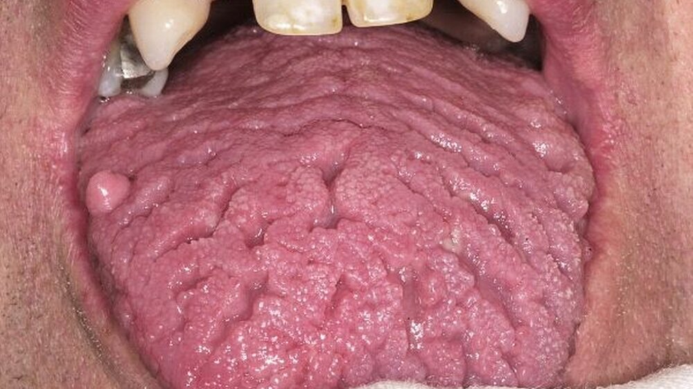 Abbildung 1: Ausgeprägte Faltenzunge (Lingua plicata) bei einem 47-jährigen Patienten