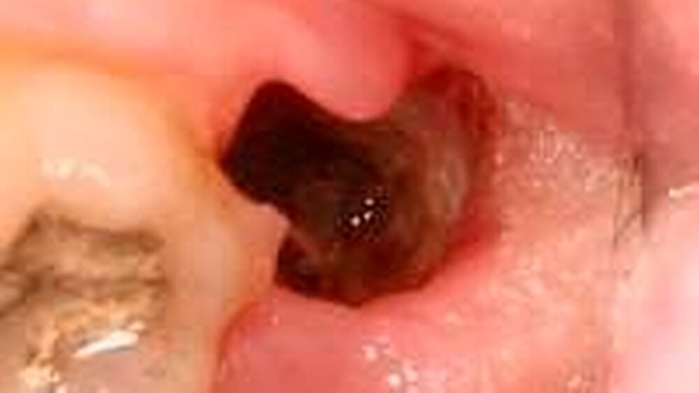 Abbildung 1: Alveolitis sicca regio 38 mit deutlich erkennbar infizierter knöcherner Alveolenwand. Fehlendes Koagel und nekrotisierende Ostitis am Alveolenrand und -grund.