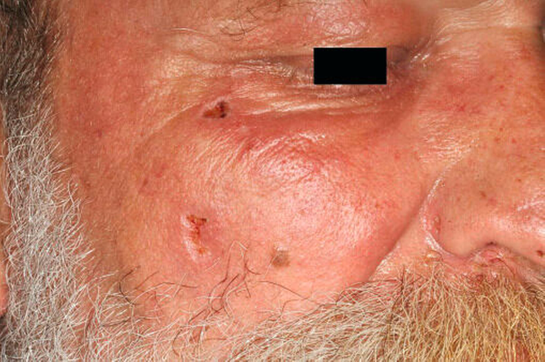 Herpes zoster im Gesichtsbereich