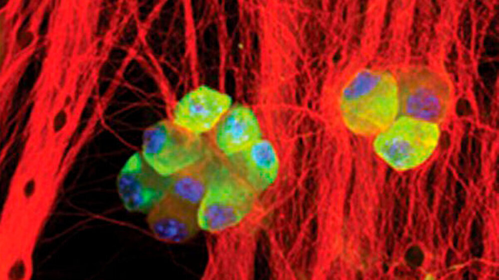 Reaktiviertes Herpes-simplex-Virus in den Neuronen