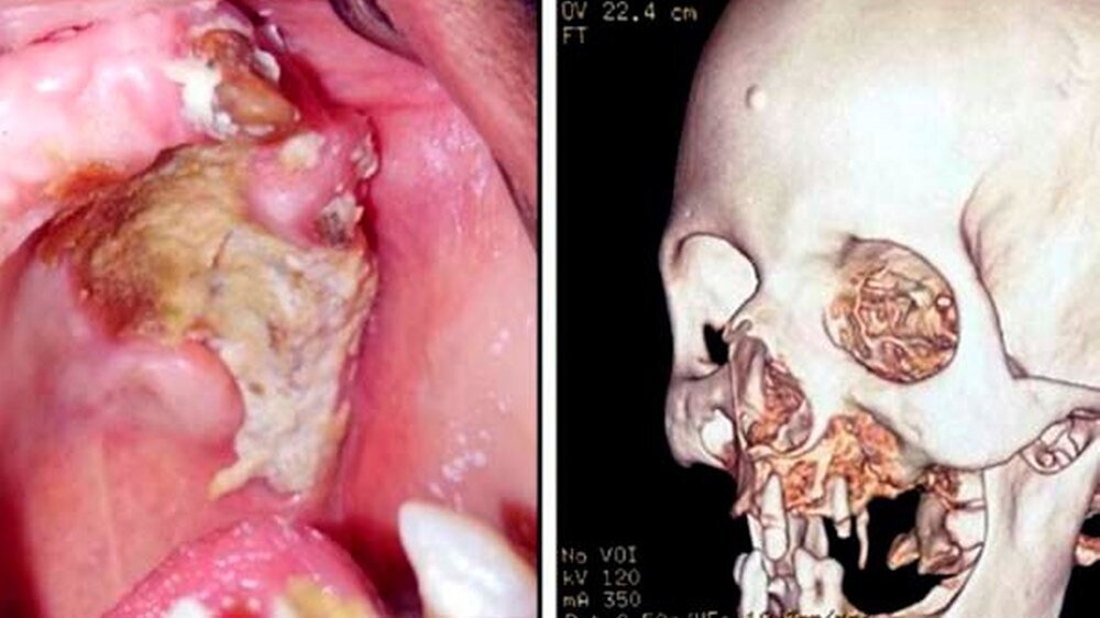 (A) Freiliegender nekrotischer Gaumen- und Alveolarknochen auf der linken Seite. (B) 3-D-CT-Darstellung zeigt Knochenzerstörung mit Beteiligung des linken Oberkiefers und des unteren Teils des Jochbeins.