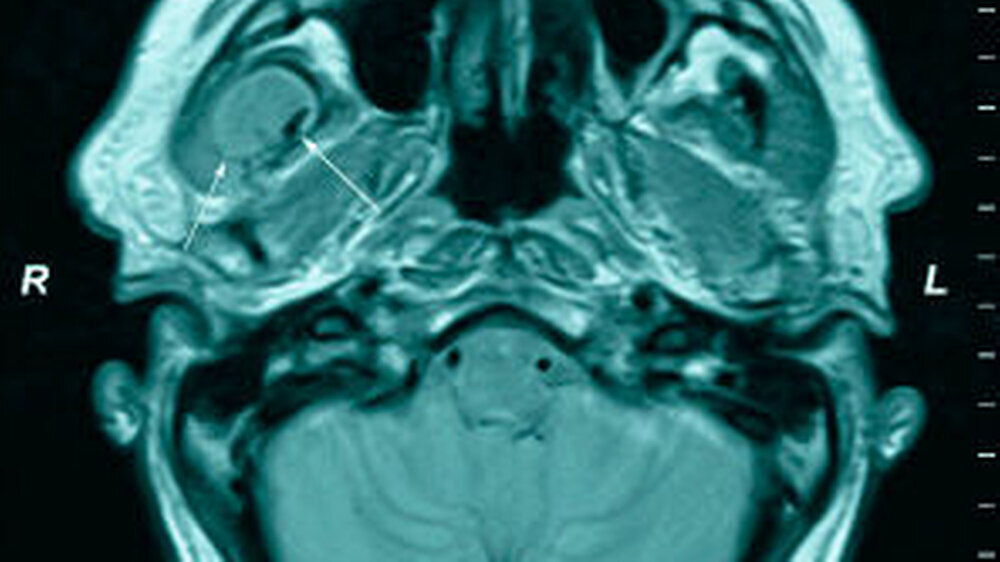 Abbildungen 1a und 1b: MRT vor Abszessspaltung alio loco in axialer (a) und in coronarer Schichtung (b) in T1-Wichtung (a) und in T2-Wichtung (b): Zu erkennen ist der Abszess mit perifokalem Ödem, dargestellt durch die Pfeile. |