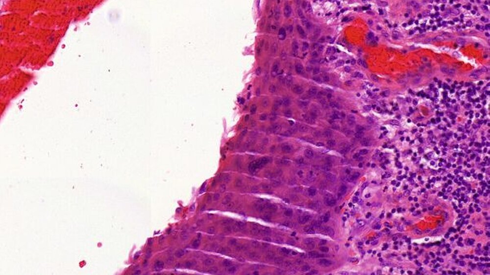 Abbildungen 6a und 6b: Das pathologische Gutachten lieferte die Diagnose einer plattenepithelialen Zyste mit fibrosiertem Zystenbalg und abschnittsweise entwickeltem Carcinoma in situ (pTis) des auskleidenden Plattenepithels bei Fehlen eines invasiven Karzinoms [mit freundlicher Überlassung durch R. Krupar, Pathologie im Uniklinikum Regensburg]. Nebenbefundlich zeigte sich eine chronisch-rezidivierende, floride Entzündung im Bereich der Nasennebenhöhlenschleimhaut. |