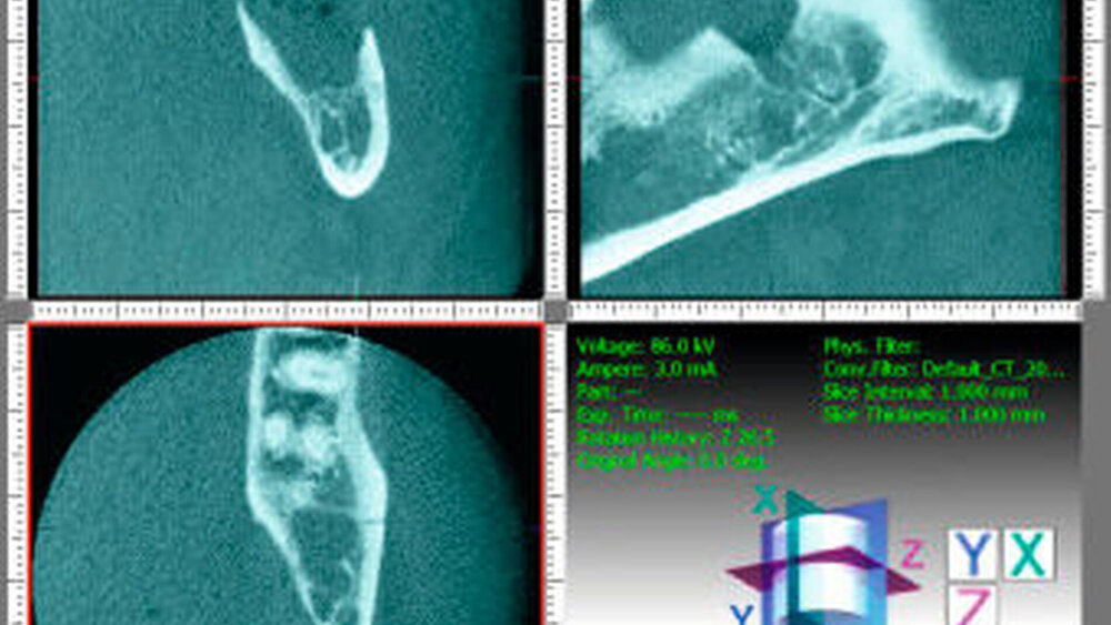 Abbildung 2: Ausschnitte der digitalen Volumentomografie mit coronarer (links oben), sagittaler (rechts oben) und axialer Ansicht (links unten): In der coronaren Ansicht ist zu erkennen, dass die vestibuläre Kompakta bei Zustand nach Weisheitszahnosteotomie eingekürzt war. In der sagittalen Ansicht (weitere Ausschnitte Abbildung 3) ist der Kieferwinkel dargestellt mit von der Region der ehemaligen Wurzelspitze liegender, nach caudal auslaufender Linie, die in die Frakturlinie übergeht (siehe Abbildung 3). |