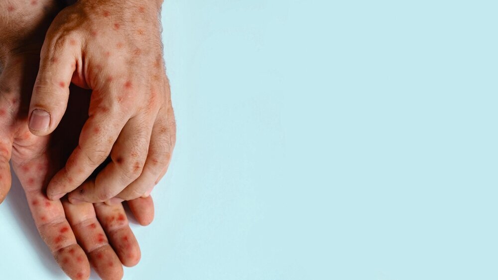 Mpox an Händen Mpox an Händen