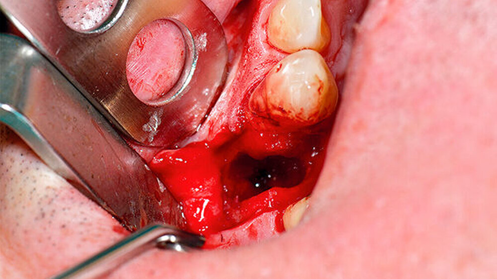 Intraoperative Defektexploration