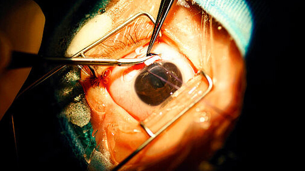 Operation eines Glaukoms |