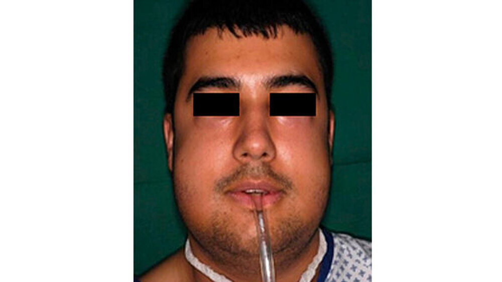 Abb. 6: Der Patient nach drei Tagen mit Redon-Drainage. Jene sollte hohen Luftdruck innerhalb der Mundhöhle vermeiden.