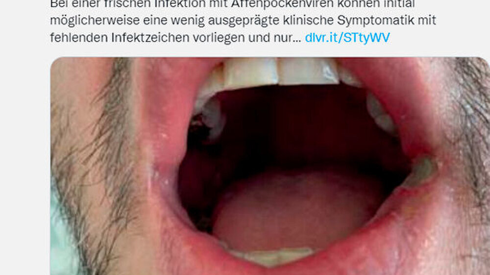 Der Patient wurde zunächst mit einem Salbenkombinationspräparat versorgt, berichtet das Deutsche Ärzteblatt. Im Verlauf weniger Tage kam es dann zu einer Ausbildung eines schmerzhaften Ulkus im Bereich des linken Mundwinkels.