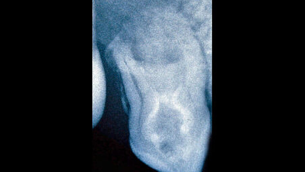 Abbildungen 2a und 2b: Oberkiefer-Zapfenzahn mit Invagination: Im Röntgenbild sind die Schmelzauskleidung der Invagination und eine periapikale Aufhellung gut erkennbar. Die Invagination führte zu einer abnormen Wurzelform. |