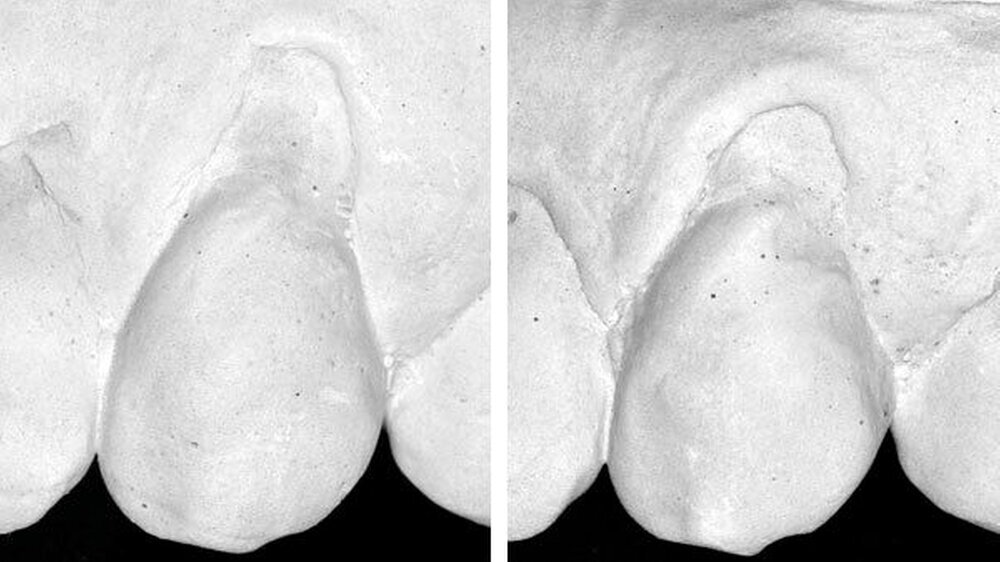 Abbildung1: Beispiele zu Veränderungen gingivalen Rezessionen: a) Zahn 23 zeigte eine Reduktion der bukkalen Rezession um 2 mm vom Anfangs- (links) zum Endbefund (rechts) nach zwölf Monaten (elektrische Zahnbürste). | Abbildung1: Beispiele zu Veränderungen gingivalen Rezessionen: a) Zahn 23 zeigte eine Reduktion der bukkalen Rezession um 2 mm vom Anfangs- (links) zum Endbefund (rechts) nach zwölf Monaten (elektrische Zahnbürste). |