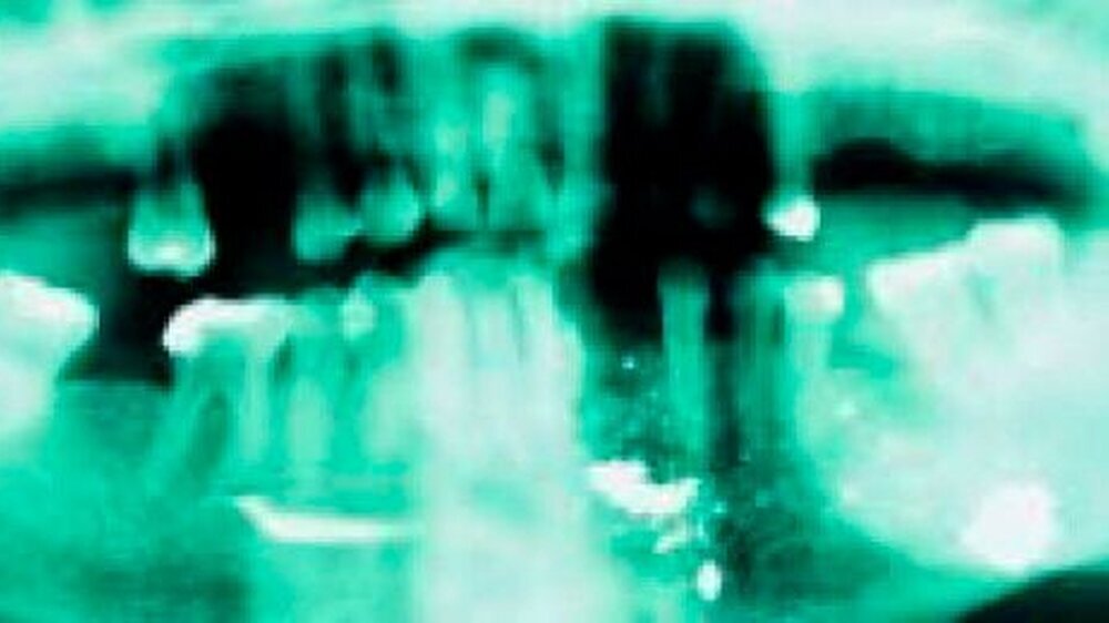 Abb.1: Auf dem Orthopantomogramm imponieren verstreute Verschattungen, die anfänglich als Artefakte gewertet wurden. Tatsächlich handelte es sich, wie sich während der operativen Versorgung herausstellte, um Projektilteilchen. Die Frakturlinien der mob