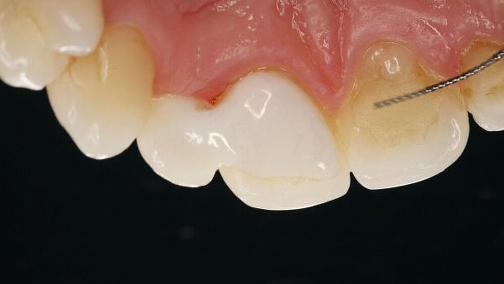 Abbildung 4: Die einflügelige Adhäsivbrücke hat sich im zehnjährigen Beobachtungszeitraum klinisch bewährt |