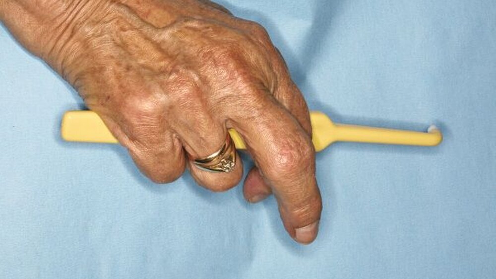 Abbildung1: Chronische Erkrankungen der Gelenke können die Handhabung von Mundhygienehilfsmitteln einschränken.