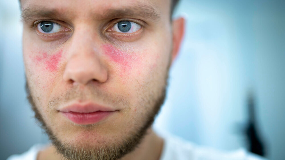 man suffers from systemic lupus erythematosus, age spots of redness on the face, a rash. lupus erythematosus