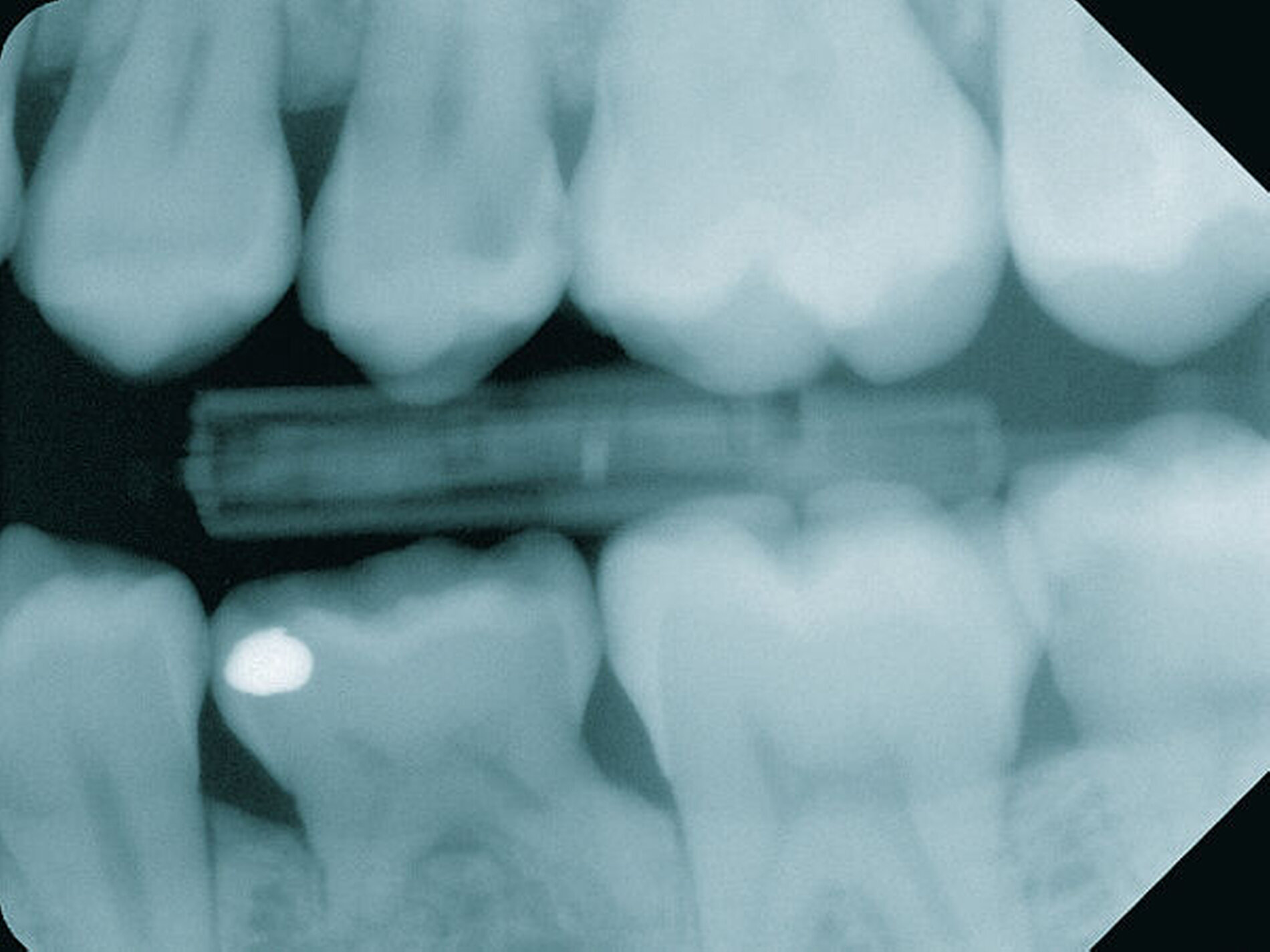 Methoden der Kariesdiagnostik – abhängig von der Zahnfläche - zm-online