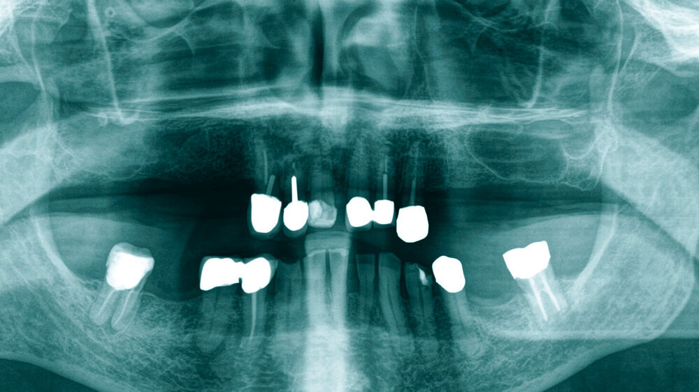 Abb. 1: Panoramaschichtaufnahme
des Patienten
vor Entfernung des Zahns 47