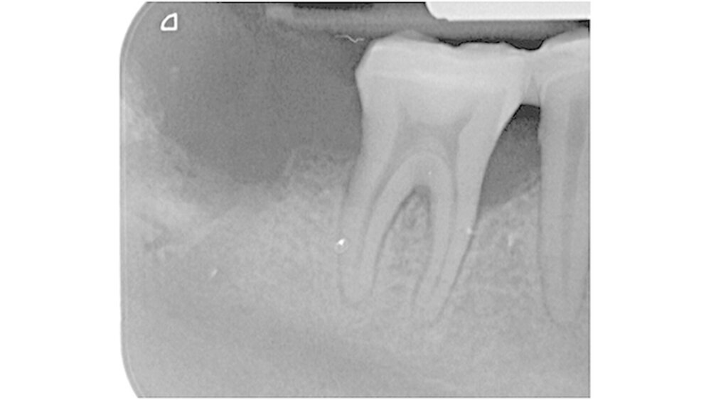 Abbildung 7: Postoperativer Zahnfilm nach Extraktion 47 und Entfernung der Füllmaterialien |