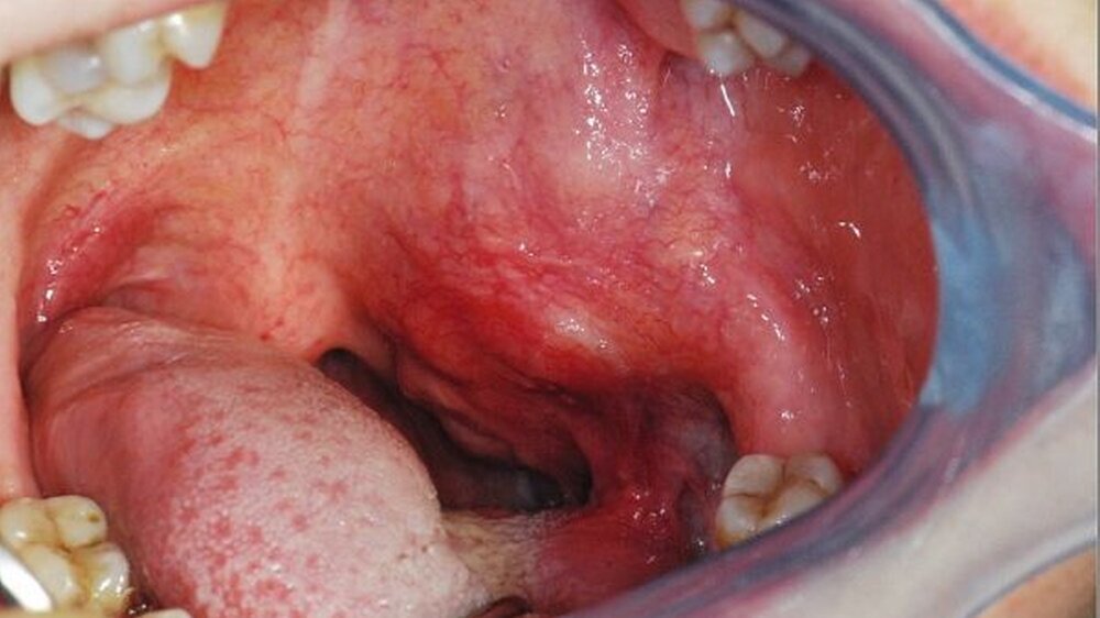 Abbildung 1: Klinischer Aspekt der Raumforderung. Das Velum erscheint vorgewölbt und lässt die höckrige Oberfläche des Tumors erahnen.