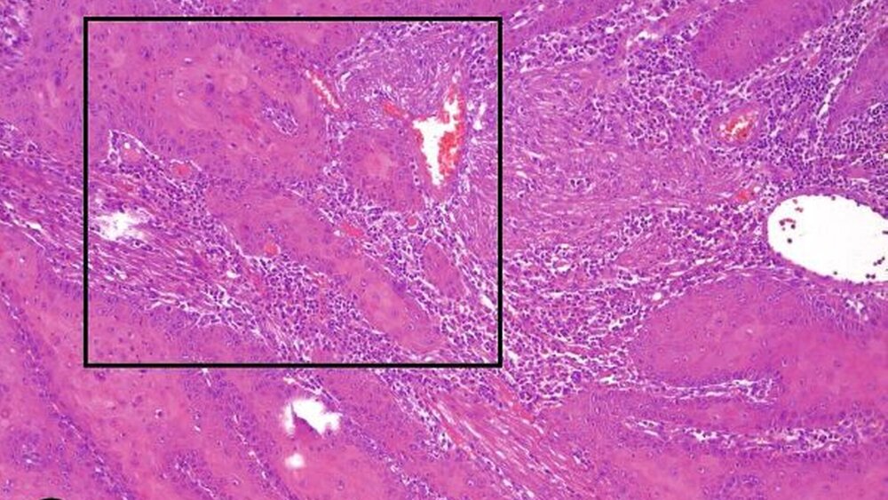 Abbildungen 3a und 3b: Histopathologischer Befund der Probebiopsie: unregelmäßiges Plattenepithel mit strukturellen und zellulären Atypien sowie flankierenden Epitheldysplasien; in Abbildung 3b erkennbares, lokal invasives Wachstum eines hoch differenzierten verhornenden Plattenepithelkarzinoms; deutliche entzündliche Überlagerung [Die histologischen Abbildungen wurden freundlicherweise von Dr. Andreas Wullbrand, Hamburg, angefertigt.] |