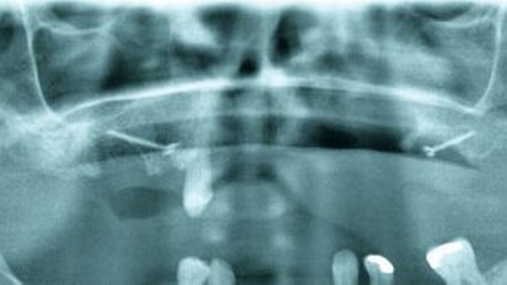 Abbildung 5: Postoperatives Orthopantomogramm: Darstellung des knöchernen Defekts; die Zähne 15, 16 und 45 wurden entfernt; metalldichte Verschattungen im Bereich des Gaumens entsprechend zweier Fixierschrauben zur Befestigung der Verbandsplatte am Oberkiefer |
