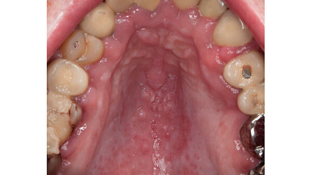 Bei einer erythematösen Candidiasis (hier am Gaumen eines HIV-positiven Patienten ohne antiretrovirale Therapie) oder bei Aphten sollte man immer auch an eine HIV-Infektion denken.