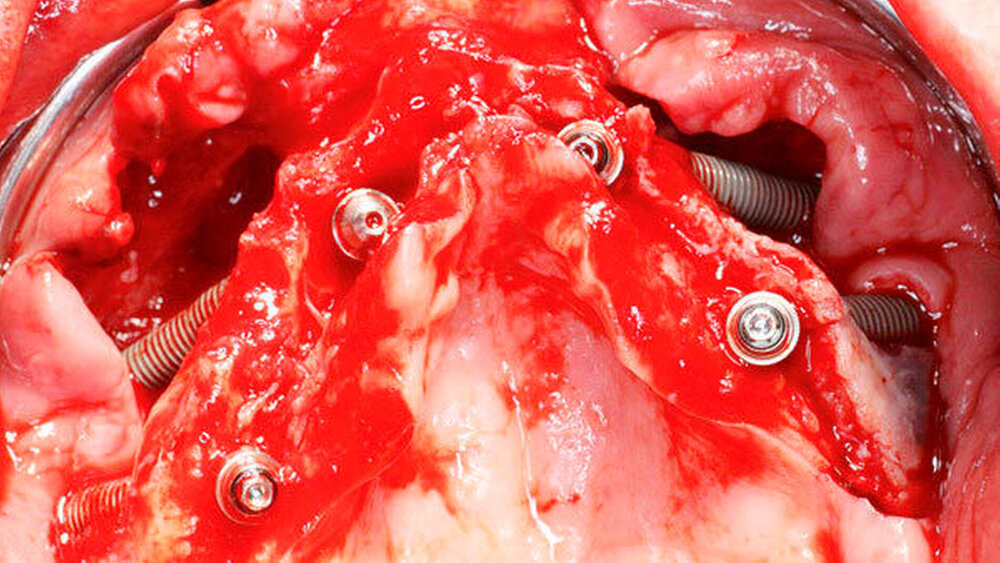 Abbildung 4 c) Basalansicht: Intraoperative Situation nach Insertion von vier Zygoma-Implantaten. |
