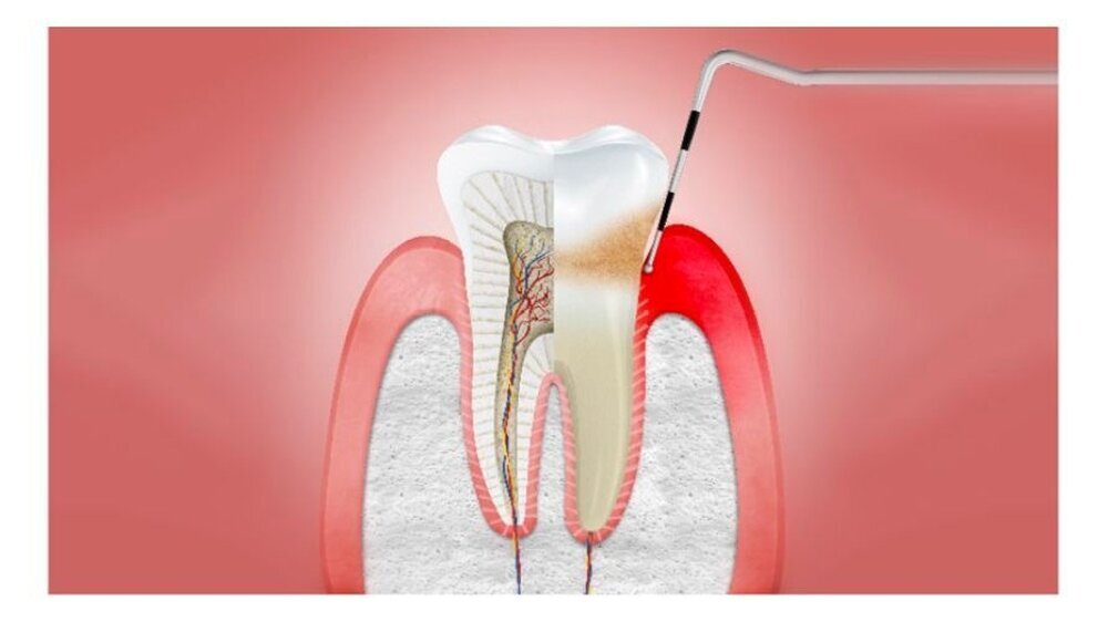 Durch Plaque verursachte Gingivitis kann vorübergehend und unterstützend mit Chlorhexamed behandelt werden. Chlorhexamed kann so zur besseren Zahnfleischgesundheit beitragen. Mehr dazu finden Sie auf unserem Portal.