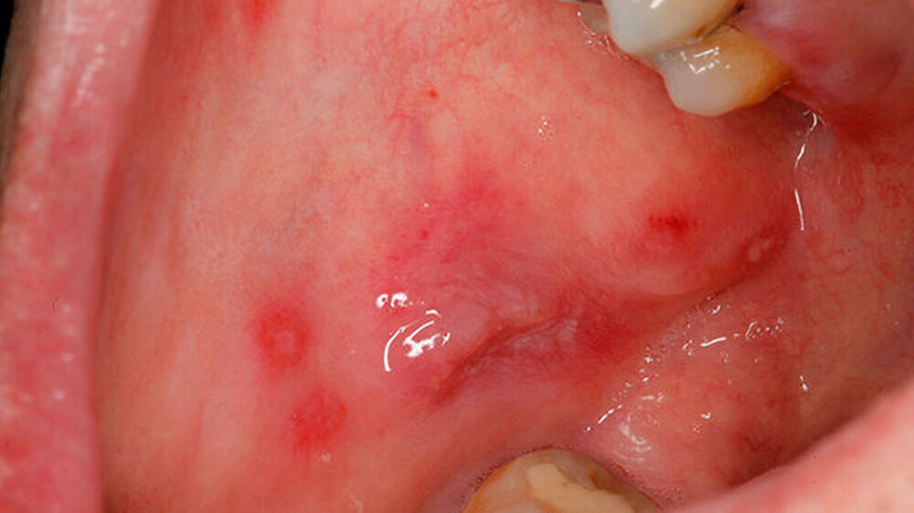 Multiple (herpetiforme) Aphthen am rechten Planum buccale (Patient männlich, 44 Jahre)