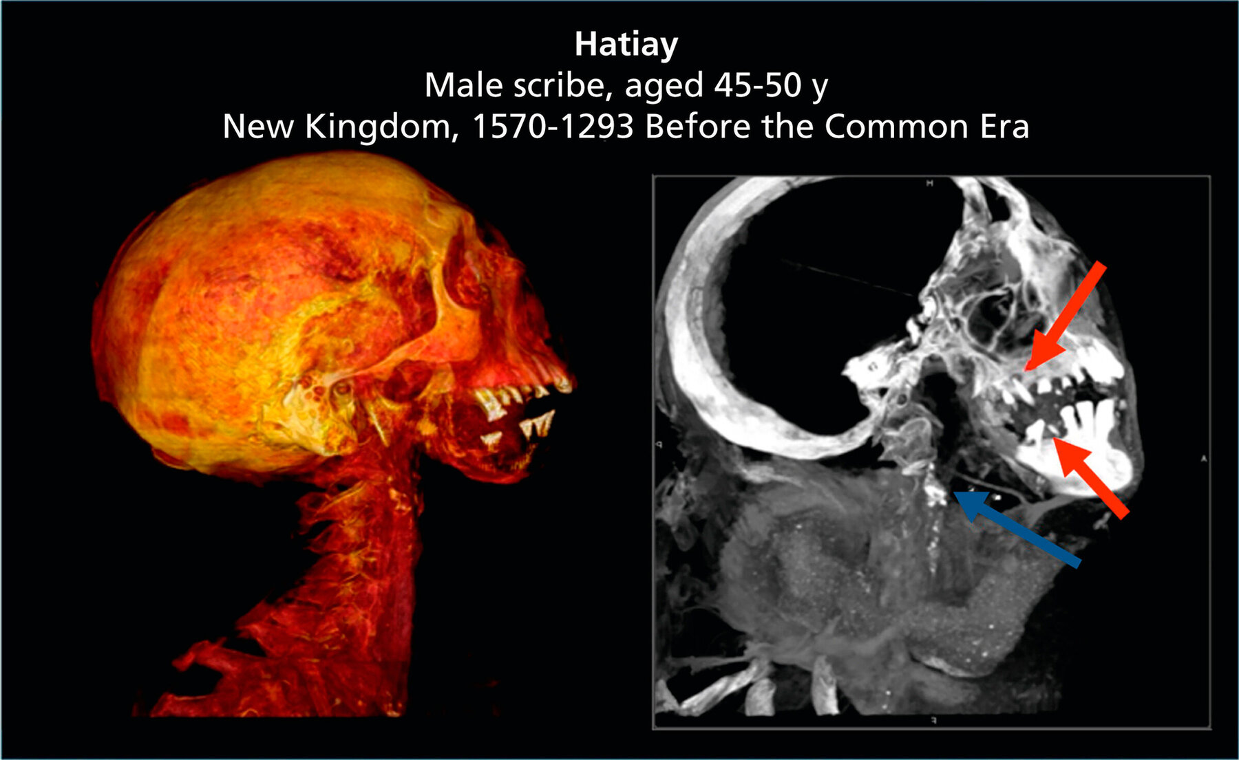 CT-Aufnahmen von Hatiay, einer Mumie mit Anzeichen sowohl von Karotisverkalkungen (blauer Pfeil) als auch von schlechter Zahngesundheit (rote Pfeile).