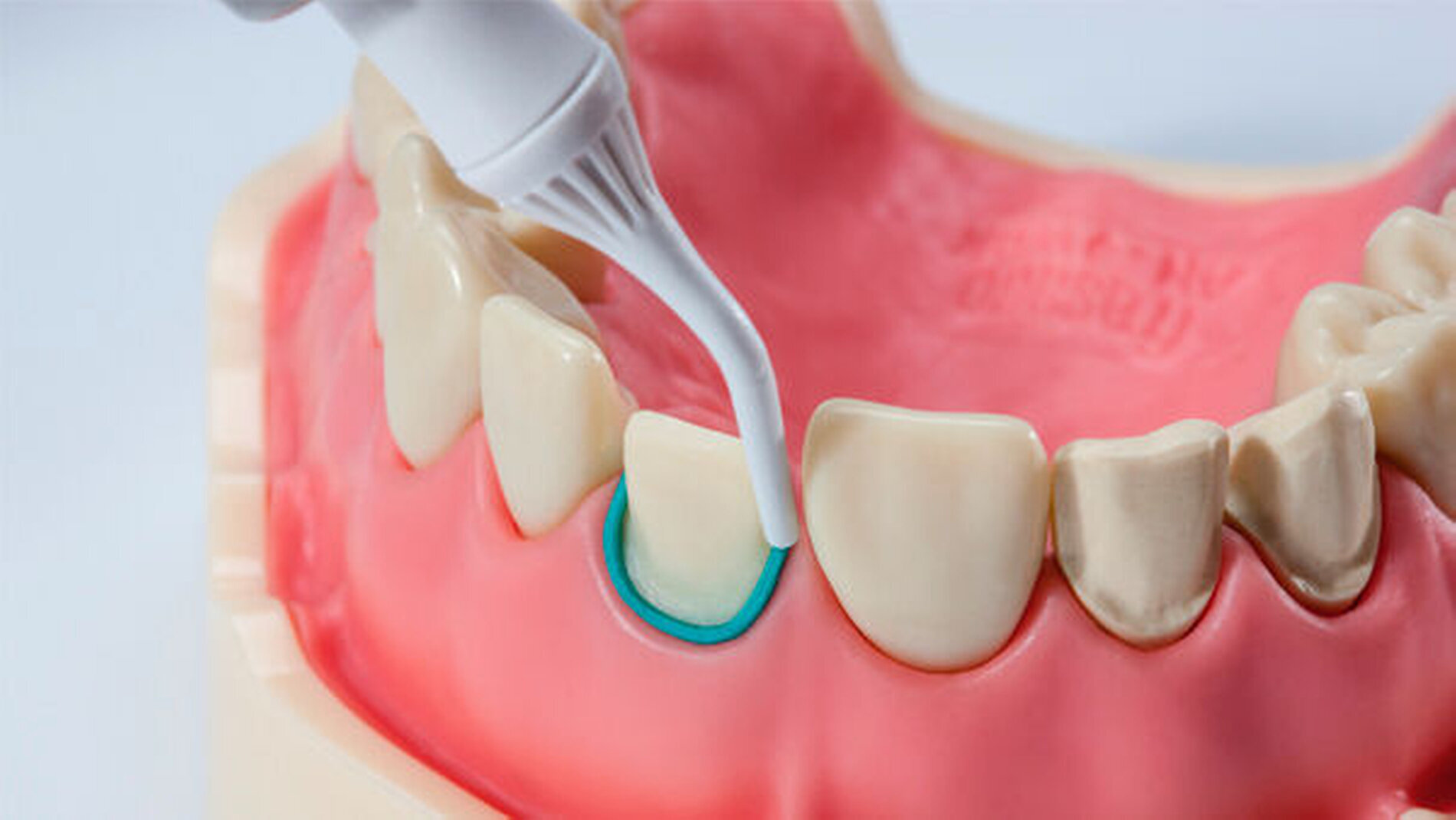 DMG Retraction Paste Retraktion leichter gemacht