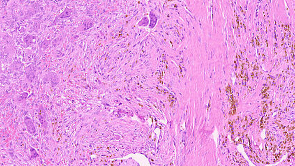 Abbildung 5: In der Vergrößerung sind die Blutungsresiduen gut zu erkennen mit der typischen Braunfärbung der Hämosiderin-beladenen Makrophagen (Vergrößerung x10). In der linken Hälfte des Bildausschnitts sind mehrere mehrkernige Riesenzellen sehen. |