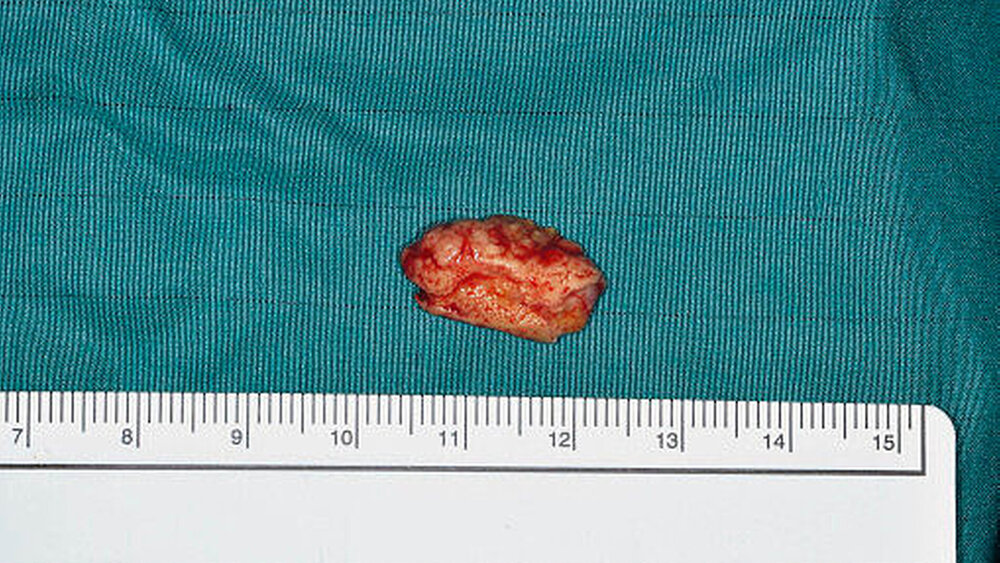 Abbildung 6:  In toto geborgener Stein mit einem Durchmesser von  2,0 cm x 1,3 cm |