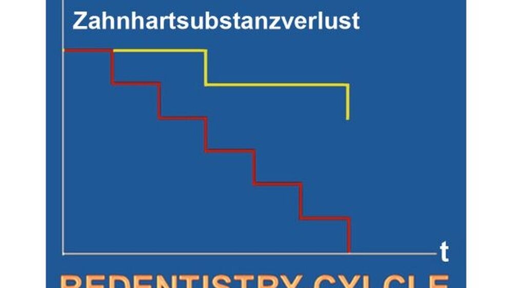 Abbildung 1: „Redentistry-Cycle“: Patient mit einmaligem Zahnarztwechsel versus Patient mit fünfmaligem Zahnarztwechsel und resultierendem Zahnhartsubstanzverlust beim Wiederholen von Restaurationen