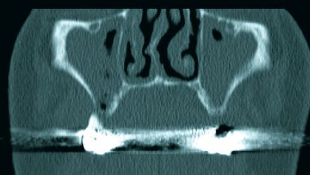 Abbildung 3: Die computertomografische Darstellung zeigt eine totale Verschattung beider Sinus maxillaris mit Verlust einer kaudalen knöchernen Begrenzung im ersten Quadranten. |
