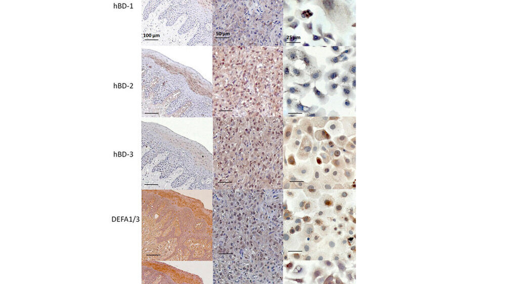 Immunhistochemische Untersuchungen zur Präsenz humaner Defensine in Gingiva, oralem Plattenepithelkarzinom (OSCC) und oralen Tumorzellen (BHY)