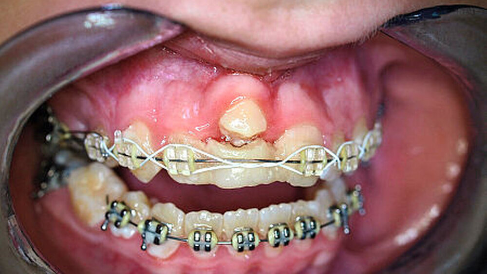 b: Zustand nach operativer Entfernung des ankylosierten Zahnes 11 und autogener Prämolaren-Transplantation 15 nach 11: Das Prämolarentransplantat steht noch in Infraposition und soll eine kieferorthopädische Einstellung erfahren. Das vertikale Weichgewebsdefizit im Vergleich zum gesunden Nachbarzahn ist noch immer gut erkennbar. |