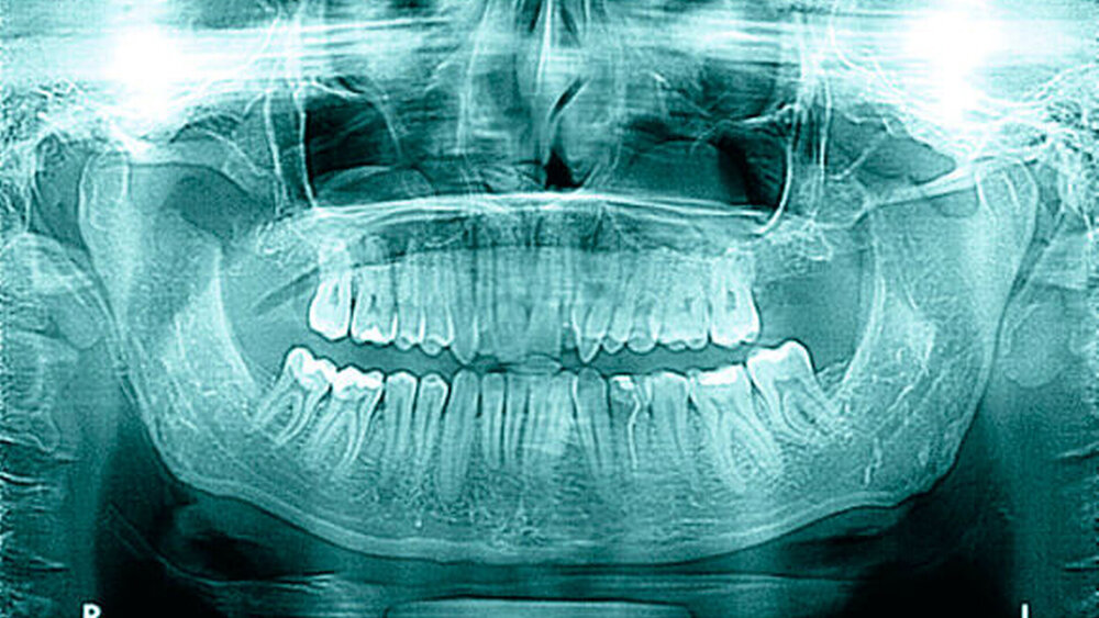 Abbildung 6: Postoperatives Orthopantomogramm bei Zustand nach beidseitiger Coronoidektomie |