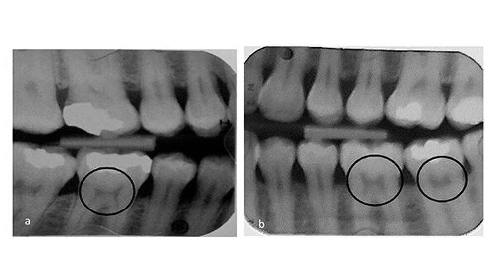a) Die Röntgenaufnahme von KT1 (Vitamin D-Mangel) zeigt die stuhlförmigen verengten Pulpahörner im linken 1. Molaren und einen stuhlförmigen 2. Molaren (schwarze Kreise);\r\nb) Die Röntgenaufnahme von TT1 (normales Vitamin D-Niveau) mit regelmäßige