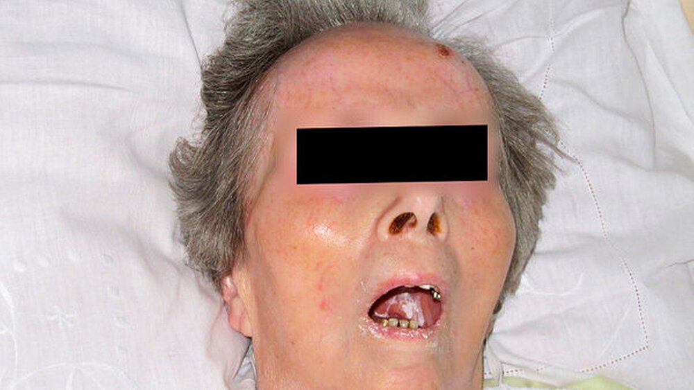 Beide Frauen sind 78 Jahre alt: Die Gruppe der Senioren ist äußerst inhomogen – von fit bis gebrechlich existiert eine enorme physiologische und psychologische Bandbreite, mit der der Mundgesundheitszustand und damit auch der Allgemeingesundheitszustand einhergeht. |