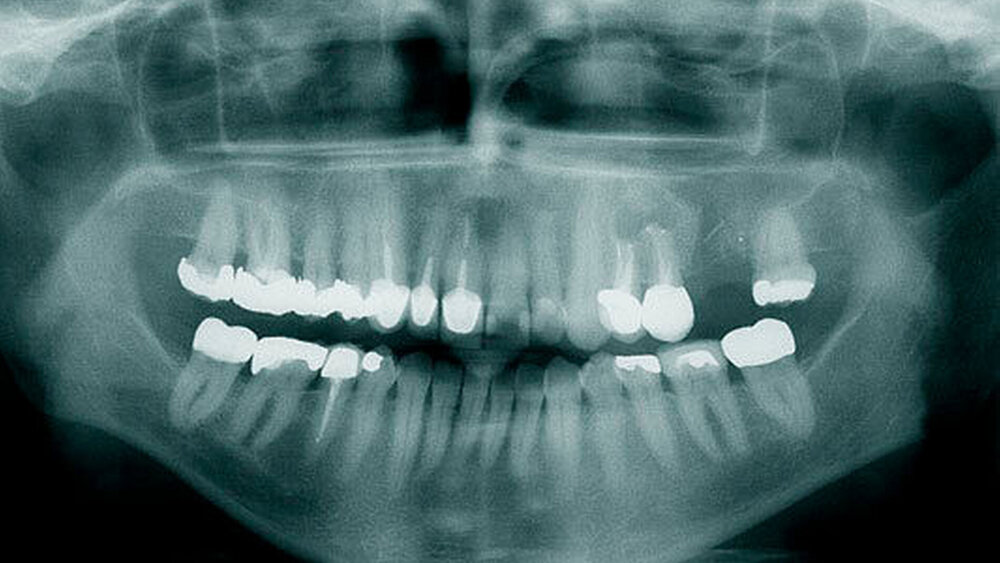 Abbildung 9: PSA – postoperative Kontrolle |