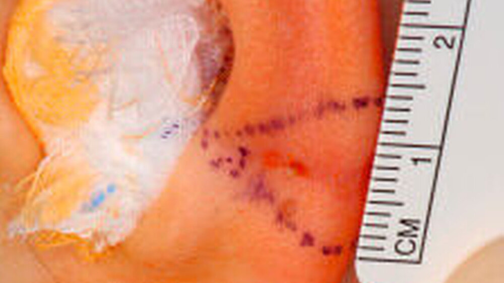 Abbildung 4: Einzeichnen der Nachresektion zur Wahrung des Sicherheitsabstands. Am Bildrand unten ist die einen Monat alte Narbe der Sentinellymphknotenbiopsie erkennbar. |