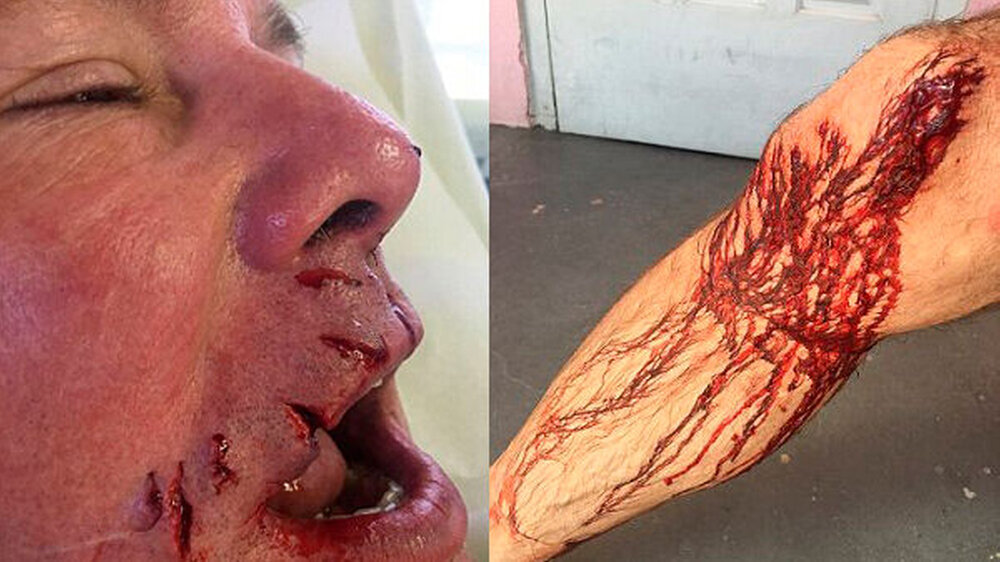 Mit 30 Stichen rund um seinen Mund und an seinem rechten Bein versorgte Krankenschwester Shekera die offenen Wunden.